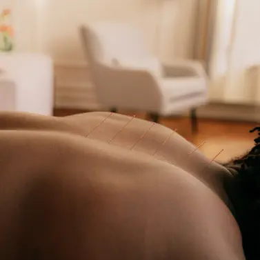 A person laying in a bed with acupuncture needles in their back.